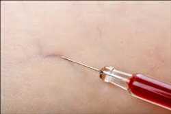 Global Microsclerotherapy Treatment Market