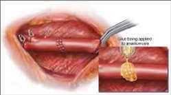 조직 실란트 및 조직 접착제 시장