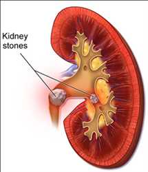 글로벌 신장 결석 관리 시장 동향