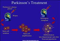 글로벌 파킨슨병 치료 시장 동향