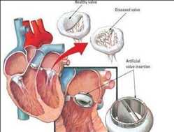 글로벌 인공 심장 판막 시장 수요