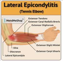 글로벌외측 상과염(테니스 팔꿈치) 치료 시장 경쟁자 분석