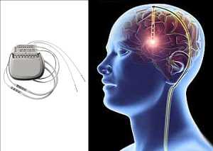 글로벌심부 뇌 자극 장치 시장 전망