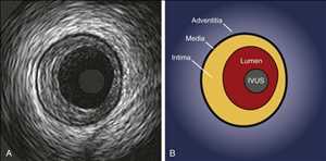 글로벌혈관내 초음파(IVUS) 시장 과거 데이터