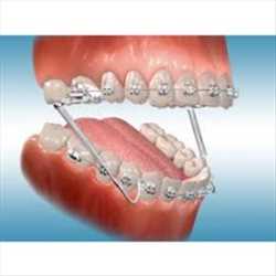 글로벌치열 교정기 시장 생산 공급