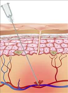 글로벌 미용 바늘 및 캐뉼라 시장 규모