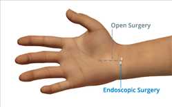 글로벌손목 터널 해제 시스템 시장 판매량
