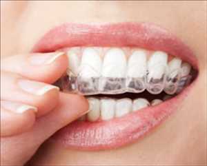 글로벌Invisalign 시스템 시장 규모