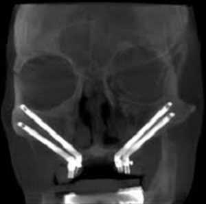 글로벌 Zygomatic 및 Pterygoid 임플란트 시장 예측