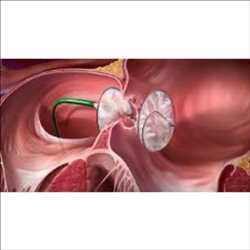 글로벌심장 결함 폐쇄 장치 시장 생산 공급