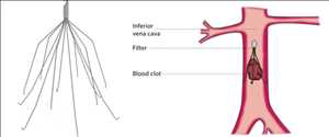 글로벌 열등한 Vena Cava 필터 (IVC 필터) 시장 점유율