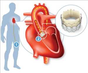 글로벌 트랜스 카테터 대동맥 판막 교체 (TAVR) 시장 통찰력